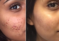 Vaarwel acne-protocol