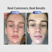 Vaarwel acne-protocol