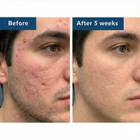 Vaarwel acne-protocol