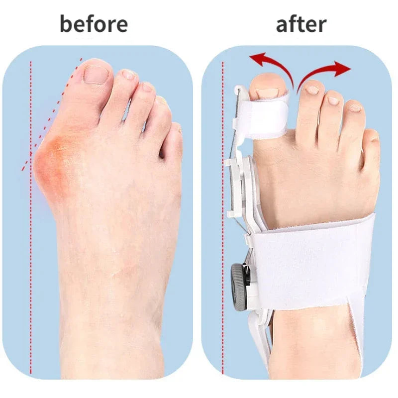 Hallux valgus corrector teenscheider