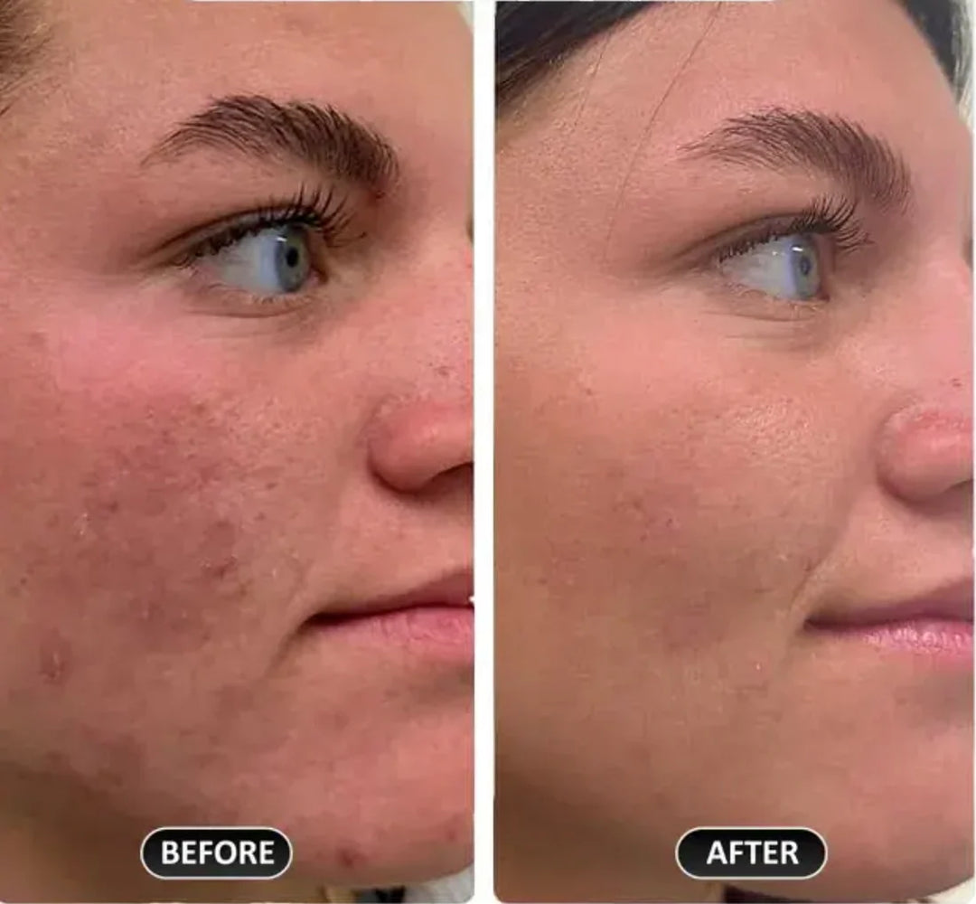 Vaarwel acne-protocol